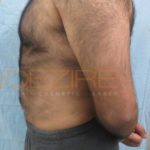 Stomach Fat Removal Surgery safe or Not in Pune