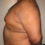 Stomach Fat Removal Without Surgery Before After in Pune