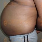 Stomach Fat Removal Without Surgery Images in Pune