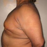 Stomach Fat Removal Without Surgery Low Cost in Pune