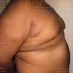 Stomach Fat Removal Without Surgery Photo in Pune