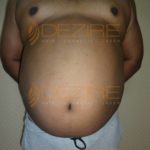 Stomach Fat Removal Without Surgery Price in Pune