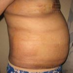 Surgery To Get Fat Removed Before After in Pune