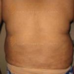 Surgery To Get Fat Removed Cost in Pune