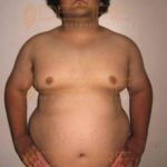 Surgery To Get Fat Removed Permanent in Pune
