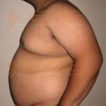 Surgery To Get Fat Removed in Pune