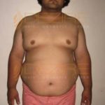 Surgery To Get Fat Removed in Pune India
