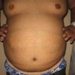 Surgery To Get Fat Removed low Cost in Pune