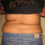 Surgery To Remove Fat From Stomach Safe Or Not Pune
