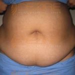 Surgery To Remove Stomach Fat Procedure in Pune