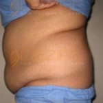 Surgery To Remove Stomach Fat in Pune
