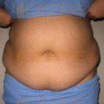 Surgery To Remove Stomach Fat in Pune India