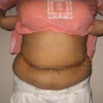 Surgery To Remove Stomach Fat in Pune World