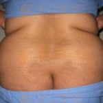 Surgery To Remove Stomach Fat low Cost