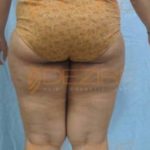 Surgical Fat Removal Safe Or Not in Pune