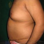 Surgical Fat Removal in Pune