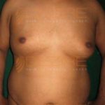 Surgical Fat Removal in Pune India