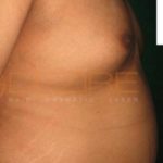 Surgical Fat Removal in Pune World