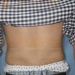 Surgically Remove Belly Fat Before After Photo Pune