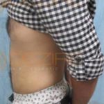 Surgically Remove Belly Fat Low Price in Pune India