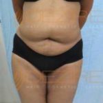 Thigh Fat Removal Surgery in Pune India