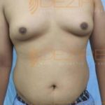 Tummy, Arm Fat Removal Surgery Pune