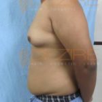 Tummy, Arm Fat Removal Surgery Pune World