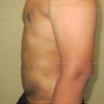 Tummy, Arm Fat Removal Surgery Safe Or Not Pune
