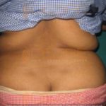 Tummy Back Fat Removal Surgery LOw Cost Pune