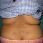 Tummy Back Fat Removal Surgery in Pune India