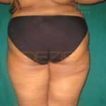 Tummy Fat Removal Surgery Cost in Pune India