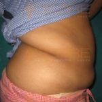 Tummy Fat Removal Surgery Low Cost in Pune