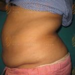 Tummy Fat Removal Surgery Low Price in Pune