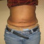 Tummy Fat Removal Surgery Safe or not Pune