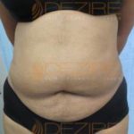 Tummy Fat Removal Surgery Success in Pune