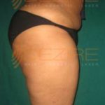 Tummy Fat Removal Surgery in Pune