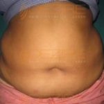 Tummy Fat Removal Surgery in Pune India