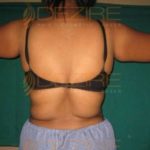 Tummy Fat Removal Surgery in World