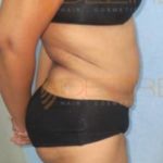 Tummy tuck Fat Removal Surgery in Pune India