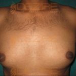 Ultrasonic Liposuction in Delhi