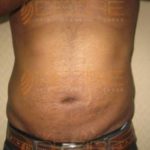 Ultrasonic Liposuction in India
