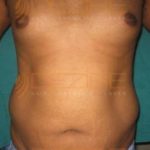 Ultrasonic Liposuction in Pune