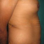 Ultrasonic Liposuction in World