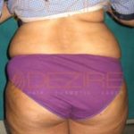 Ultrasound Fat Reduction Success In Pune