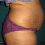 Ultrasound Fat Reduction in Pune