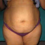Ultrasound Fat Reduction in Pune India