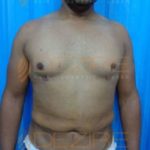 Ultrasound Fat Removal Side Effect Pune