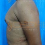 Ultrasound Fat Removal in Pune World