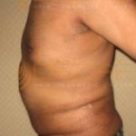 belly fat removal surgery side effects Pune