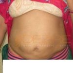 coolsculpting before after Pune